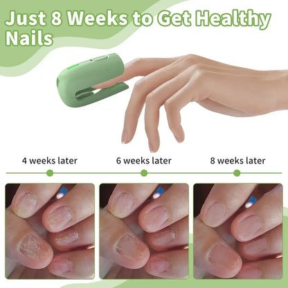 Nail Fungus Cleaning Device - QayyoomLux